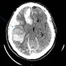 Candida auris encephalitis