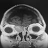 MRI with gadolinium showing an enhancing mass
