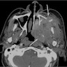 CT of maxillary sinus squamous cell carcinoma