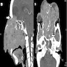 CT of large exophytic squamous cell carcinoma