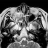 Maxillary sinus adenocarcinoma MRI