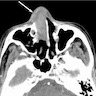 Sinonasal undifferentiated carcinoma CT