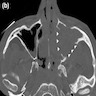 SCC bone destruction CT