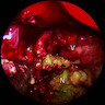 Endoscopic view of squamous cell carcinoma
