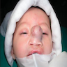 External nasal lesion with skin tightening