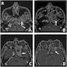 MRI: Enhanced mass in the fossa of Rosenmüller