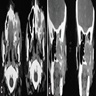 Mass of maxillary sinus