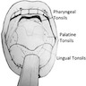 Lingual tonsil