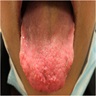 Innumerable small nodules on the tongue