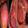 Nodules on tongue, buccal mucosa and labial mucosa