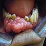 Diffuse erythema and edema of the gingiva