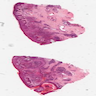 Pseudoepitheliomatous Hyperplasia in Blastomycosis Infection of the Skin