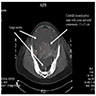 CT abdominal mass & ascites