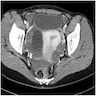 CT: ruptured corpus luteum cyst and hemoperitoneum