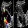 Follicle cyst on ultrasound