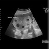 Ovarian stromal hyperplasia