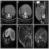 CT and MRI: large mass