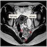 MRI: mass near ovary