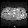 Bilateral ovarian fibroma on MRI
