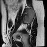 Unilateral ovarian fibroma on MRI