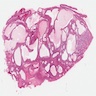 Metastatic pancreatic adenocarcinoma to the ovary