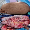 Distended abdomen and surgical impression
