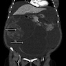 CT abdomen and pelvis of cystic mass