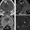 Pelvic MRI of cystic mass