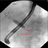 ERCP with stricture
