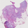 Pancreatic ductal adenocarcinoma with foamy gland features