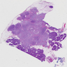 Pancreatic ductal adenocarcinoma, NOS