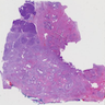 Pancreatic ductal adenocarcinoma with clear cells and foamy gland features