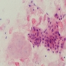 Squamous epithelium, keratinaceous debris and lymphocytes