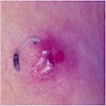 Cutaneous (furuncular) myiasis