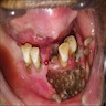 Maggots in the mandible