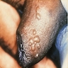 Herpetic vesicles of penis