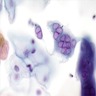 HSV infected squamous cells