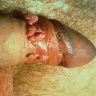 Multiple exophytic and warty lesions on the shaft and glans of the penis