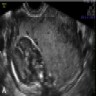 Ultrasound shows a thick and inhomogeneous placenta