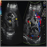 Ultrasound Doppler of placenta percreta