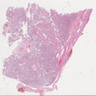 Placenta increta