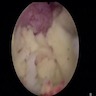 Xanthogranulomatous prostatitis with abscess