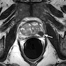Prostatic hypointense lesion (MRI)