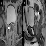 Pelvic MRI, seminal vesicle mass