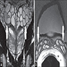 Normal seminal vesicles