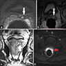 Seminal vesiculitis