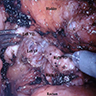 Seminal vesicles