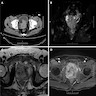 CT and MRI of prostate