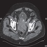 Pelvic CT with contrast