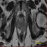 MRI of prostate